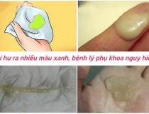 Ra khí hư màu xanh như nước mũi có mùi tanh là dấu hiệu bệnh gì
