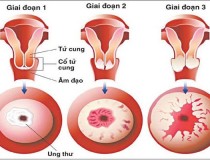 Dấu hiệu ung thư cổ tử cung giai đoạn đầu