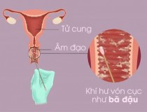 Ra nhiều khí hư màu trắng như bã đậu