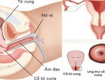 Bệnh ung thư cổ tử cung: Nguyên nhân, dấu hiệu và điều trị