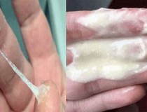 Khí hư màu trắng sữa là bệnh gì