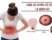 Chữa đốt viêm lộ tuyến cổ tử cung ở đâu tốt  tại Hà Nội?